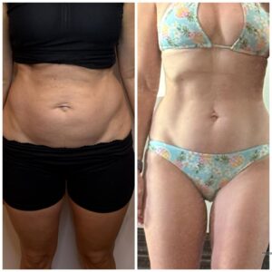 Real before & After Cryotherapy, Cryotherapy Sirius